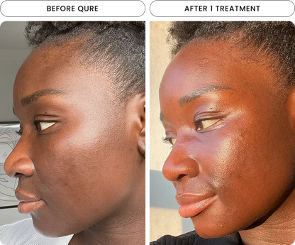 Micro-Infusion Facial System