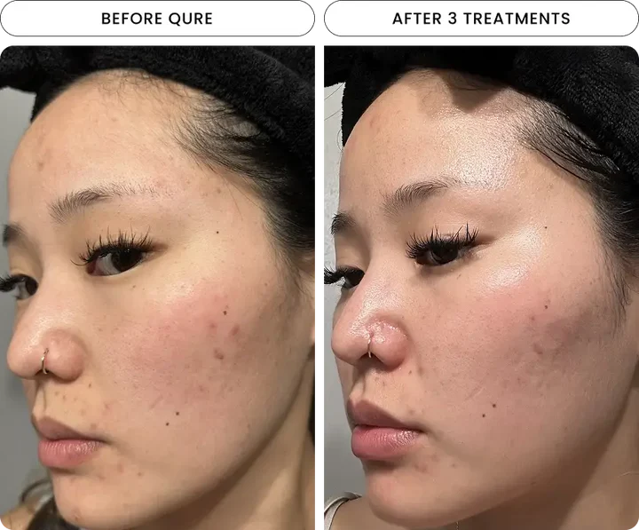 Micro-Infusion Facial System